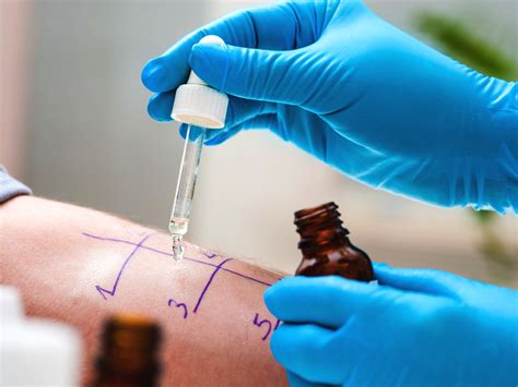 scratch test for food allergies|rast test vs skin prick.